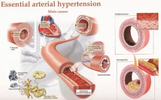 Maladie hypertensive (Hypertension artérielle essentielle)