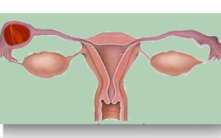 La grossesse extra-utérine (GEU)